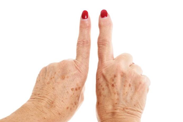 deformējoša artroze uz pirkstiem