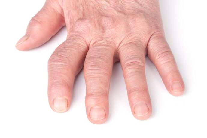 deformējoša artroze uz rokām