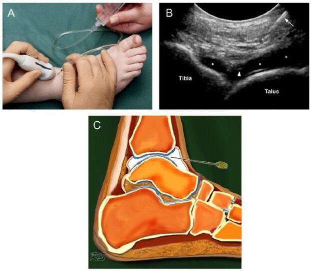 potītes locītavas ultraskaņa ar artrozi