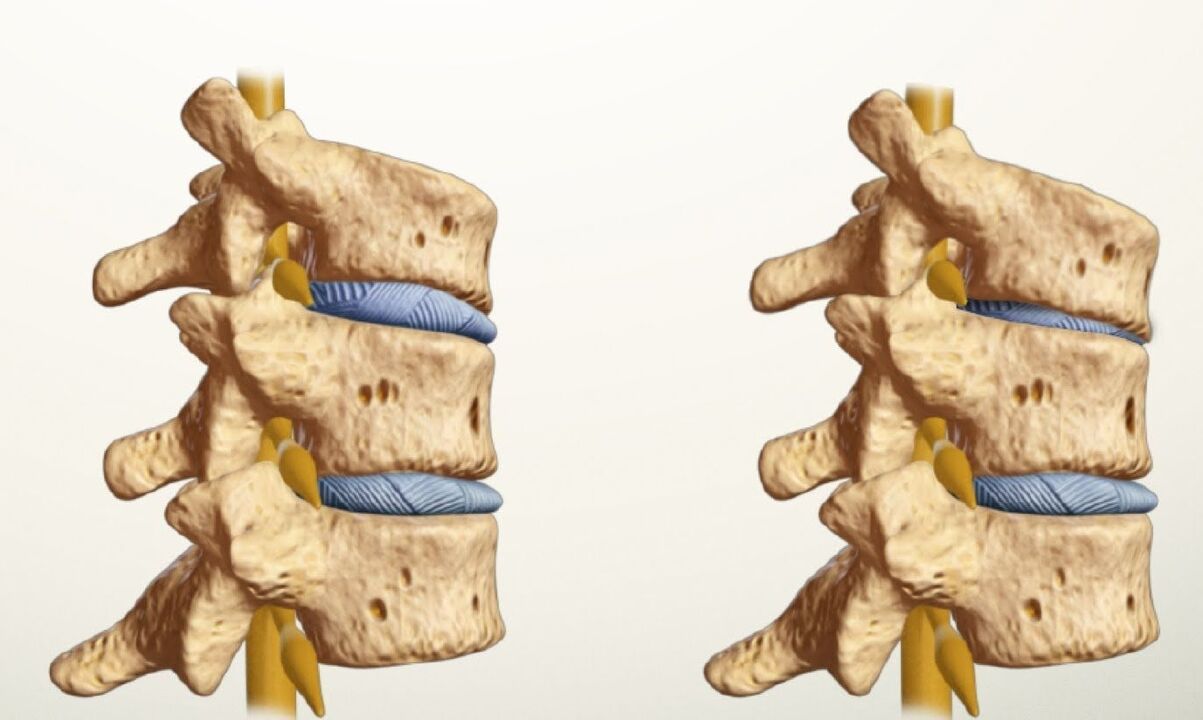 vesels un slims mugurkauls ar jostas daļas osteohondrozi