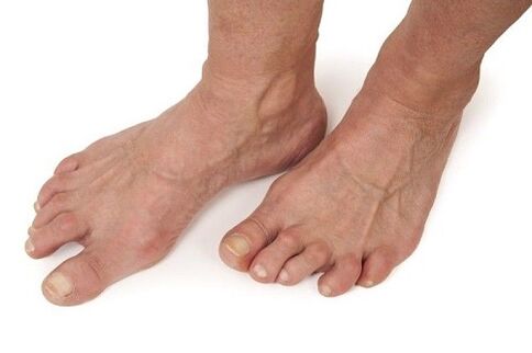 artrozes skartās pēdas