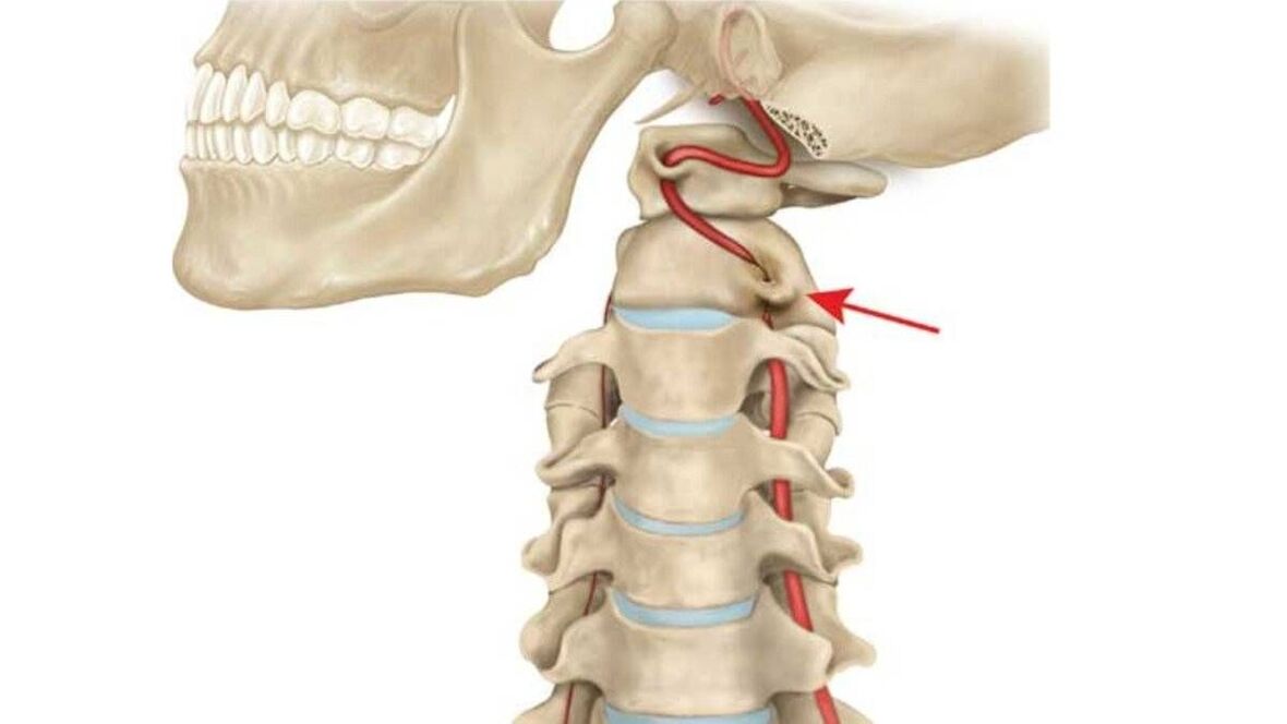 mugurkaula kakla daļas osteohondroze