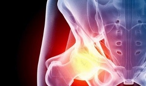 gūžas locītavas artrozes attīstības cēloņi