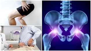 mugurkaula osteohondrozes klasifikācija