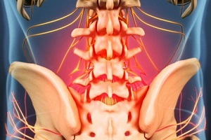 osteohondrozes cēloņi un simptomi