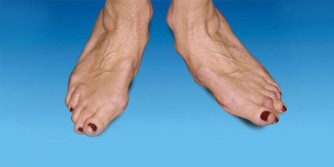 pēdas deformācija ar potītes artrozi