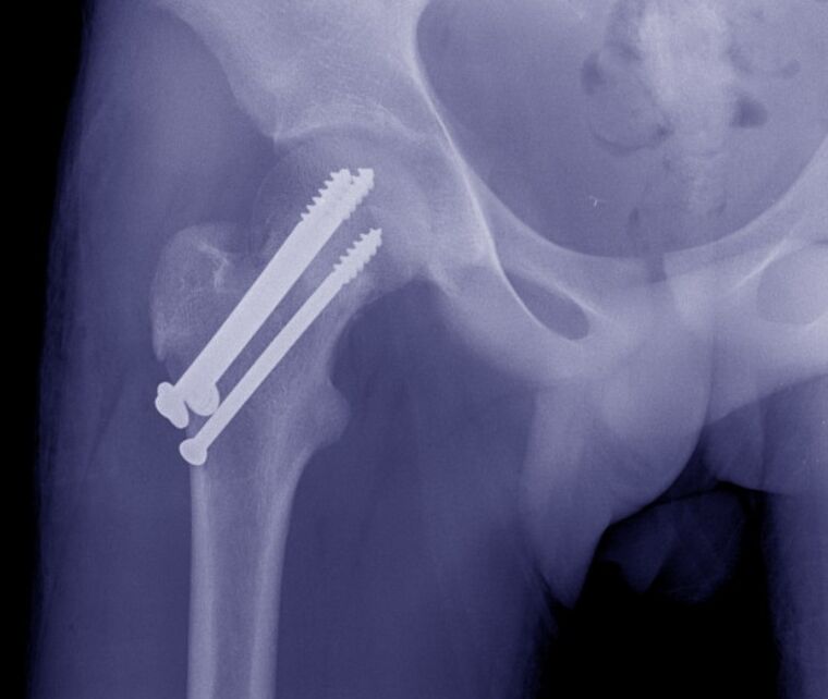 Gūžas locītavas rentgens, lūzuma osteosintēze ar iekšējām fiksācijas ierīcēm