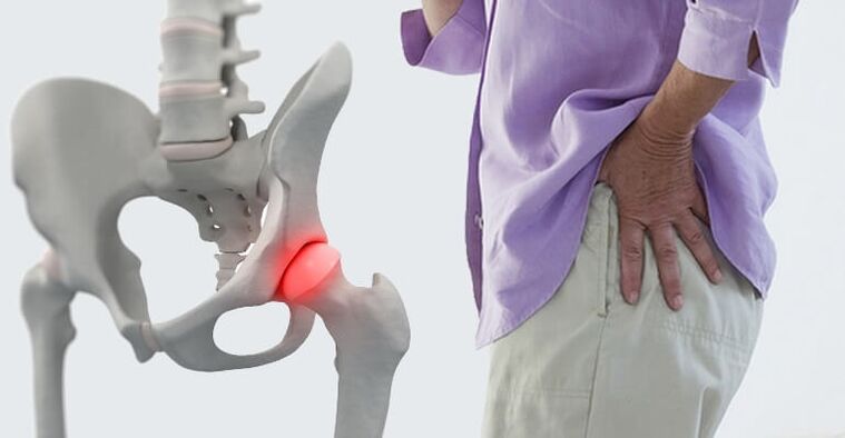 sāpes gūžas rajonā - gūžas locītavas artrozes simptoms
